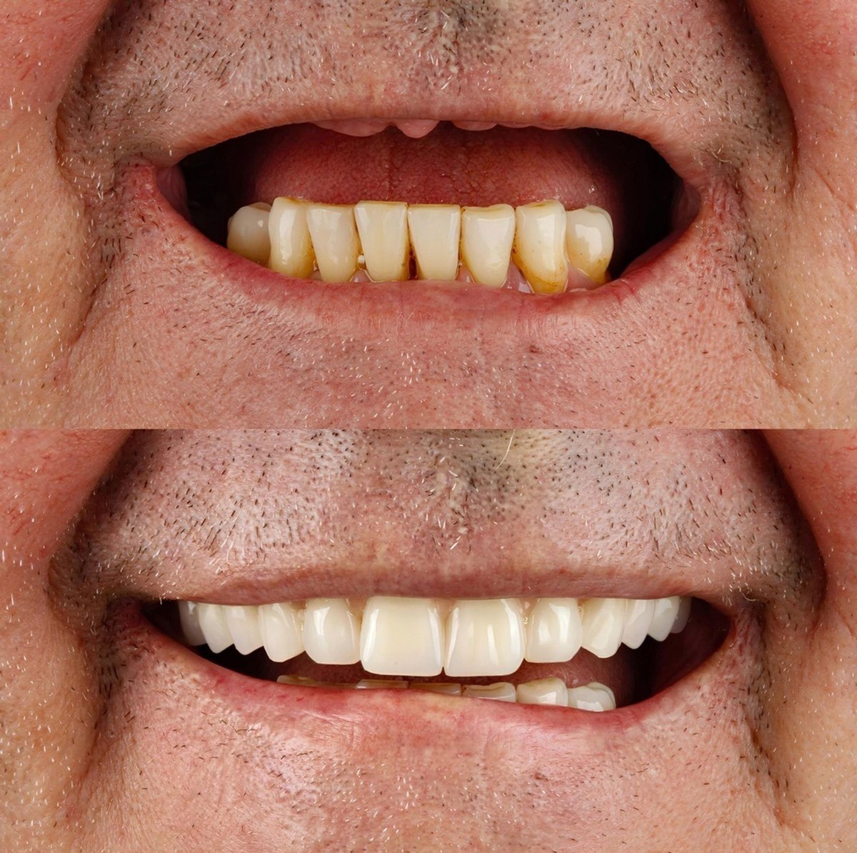 Full Mouth Rehabilitation Procedure