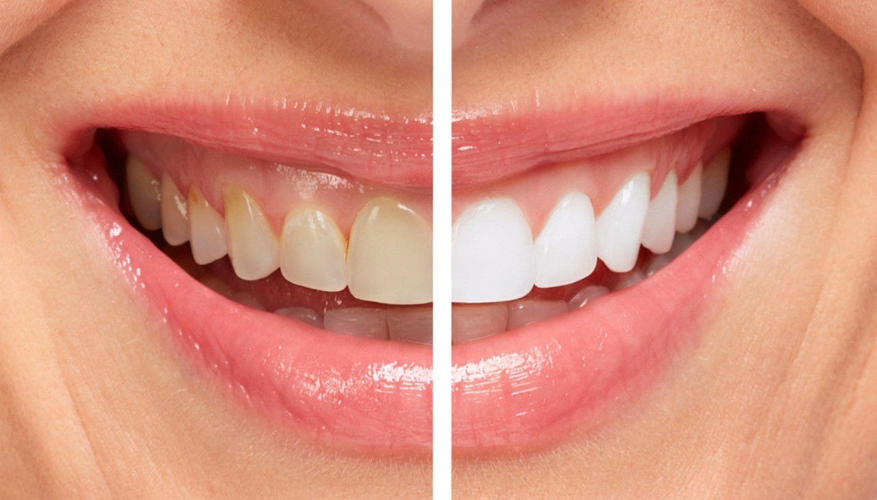 Professional Teeth Whitening Procedure