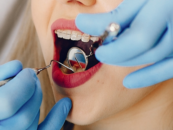 Dental Implant Procedure Steps at The Tooth Story Hyderabad