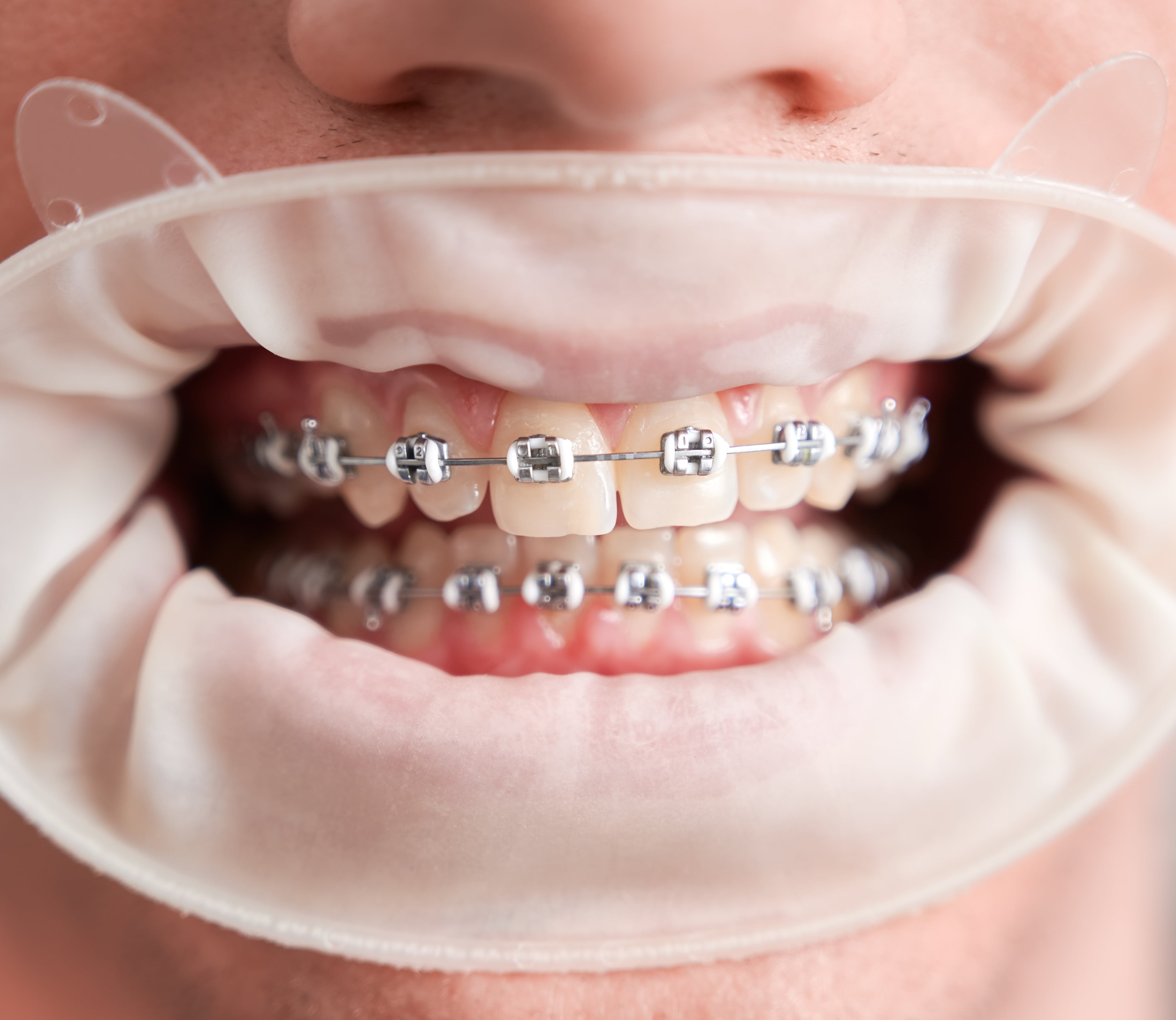 Types of Braces